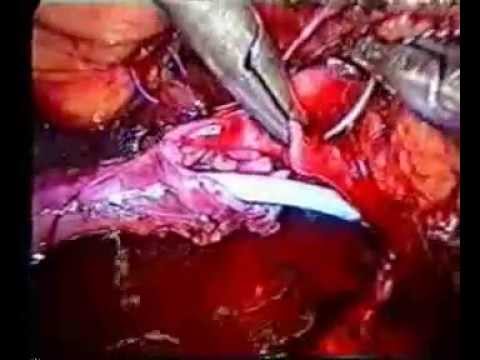 keyhole pyeloplasty laparoscopic