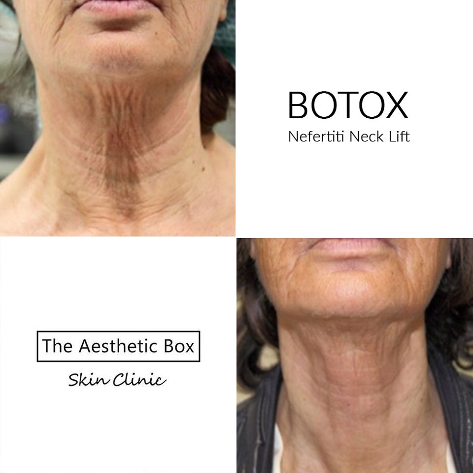 BOTOX treatment in Milton Keynes upper face wrinkles reduction treatment