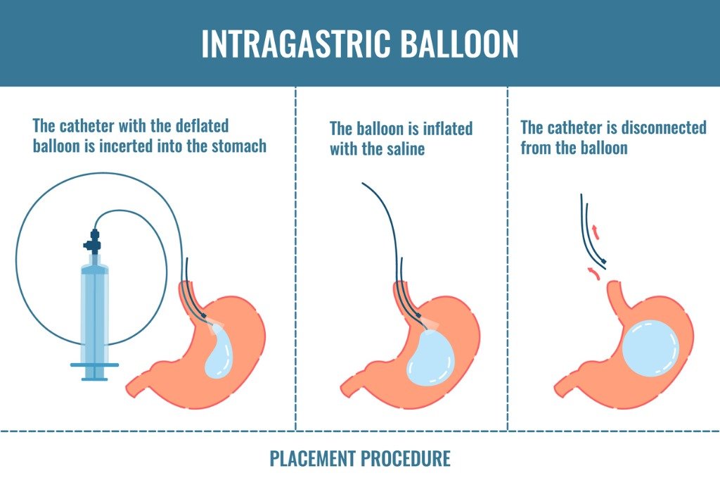 Magenballon Gastric Ballon