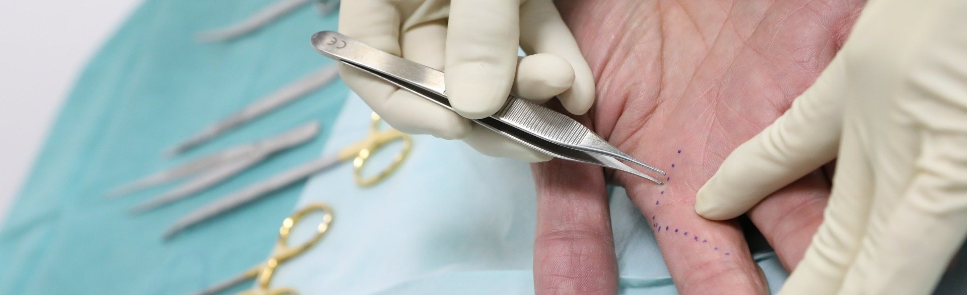 Ambulante Operationen Handchirurgie und Hautchirurgie