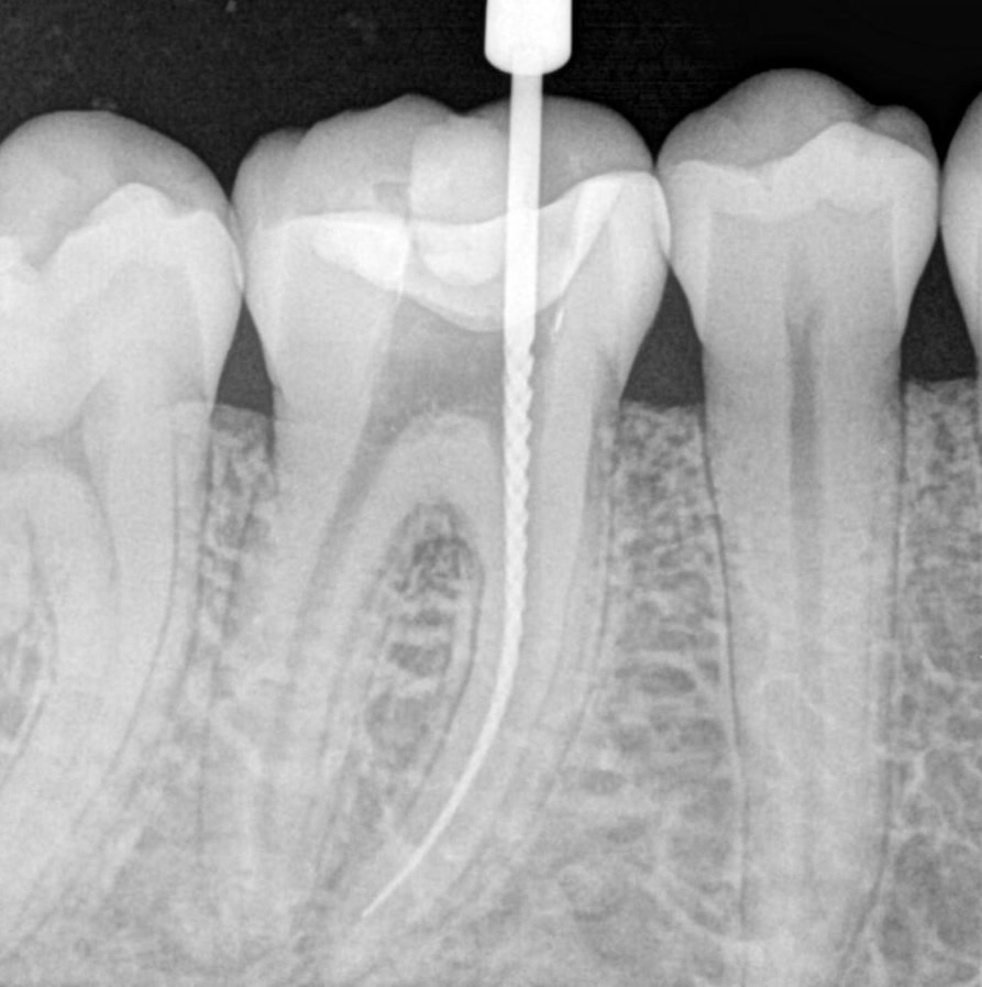 Endodoncia ¿Qué debo saber?.Clínica Cámara.Dentista Granada y jaén.
