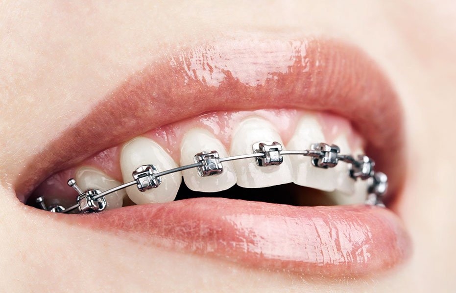 Ortodoncia ¿Qué debo saber?¿existe la ortodoncia invisible?.