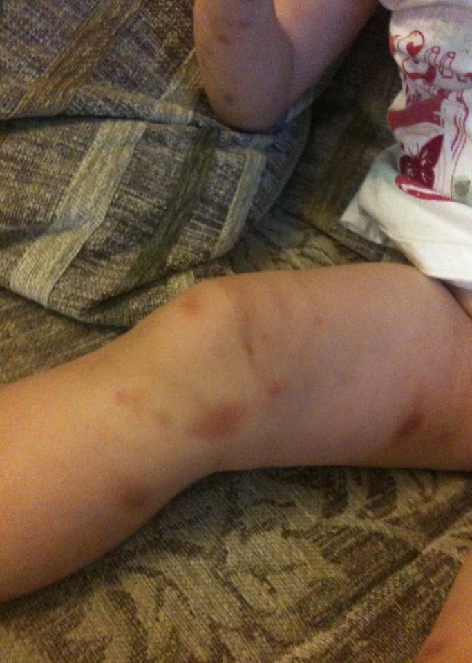 Vascular Ehlers-Danlos Syndrome - UK Registered Charity