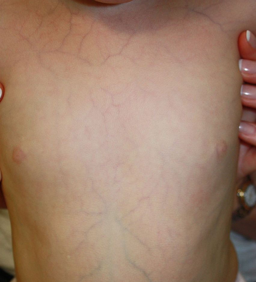 Vascular Ehlers-Danlos Syndrome - UK Registered Charity