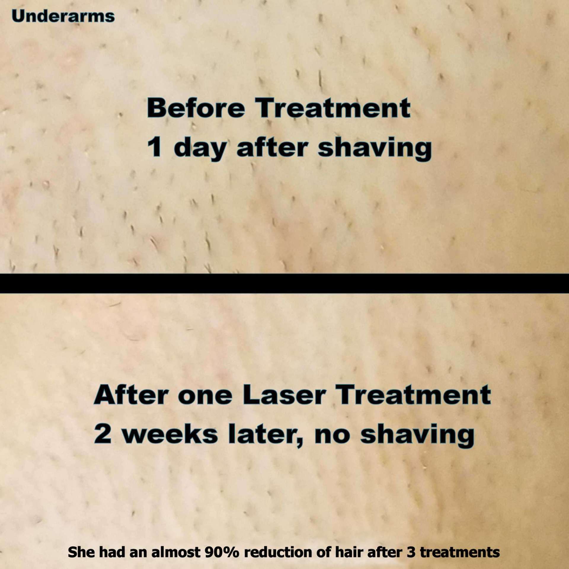 MFM Laser Center 1 Laser Hair Removal in Atlanta