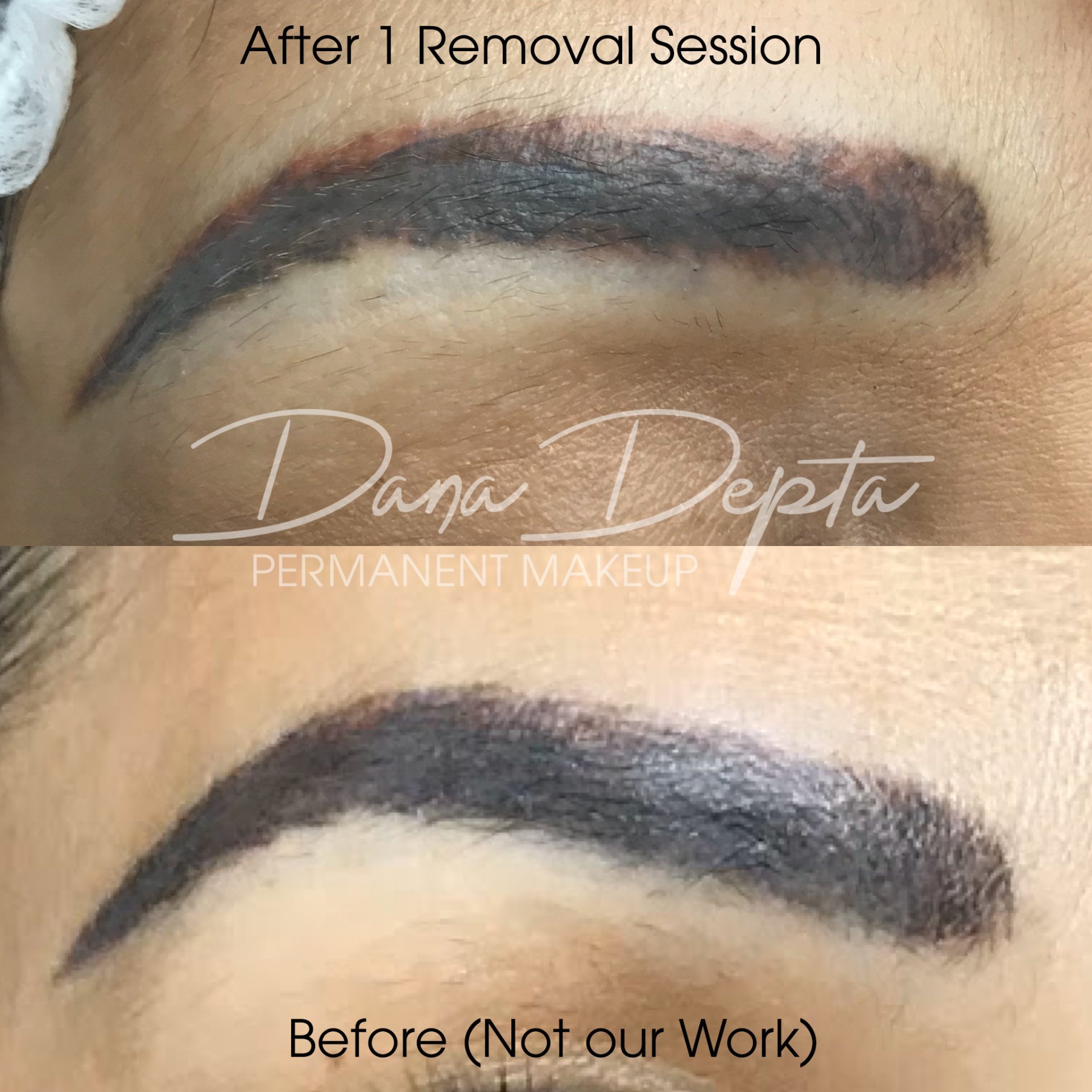 Saline Removal Photos | Dana Depta Permanent Makeup