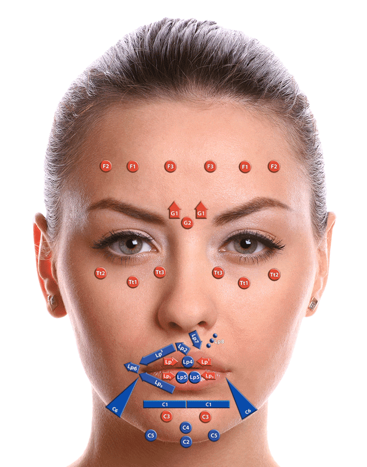 Juverderm, Hyaluronfiller, Allergan MD Codes de Maio, Faltenunterspritzung mit Hyaluron, Allergan, Juvederm