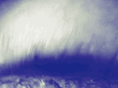 Sehnerventzündung MS Auge Opticus Neuritis Sehstörung