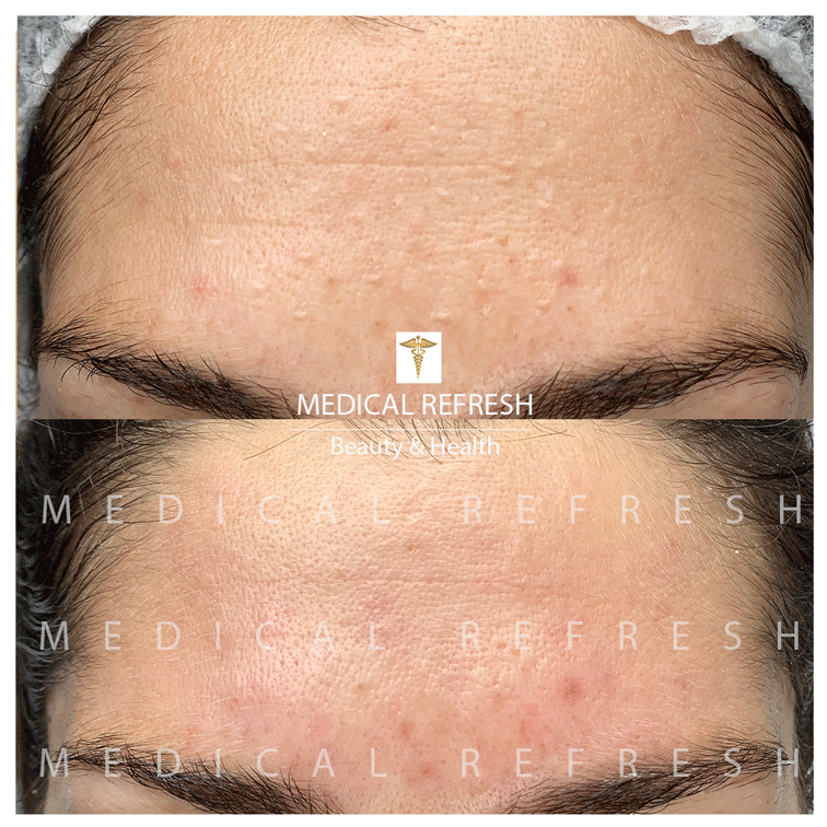 Fruchtsäurepeeling München – Kosmetikerin bei professioneller AHA Peeling Behandlung