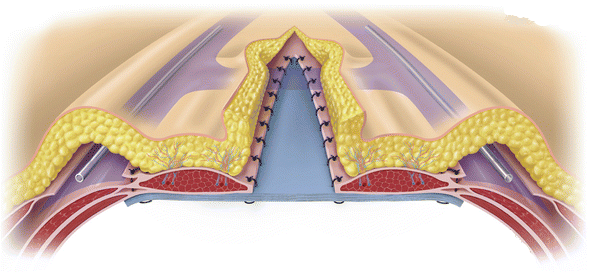 Riparazione laparocele - ricostruzione parete addominali