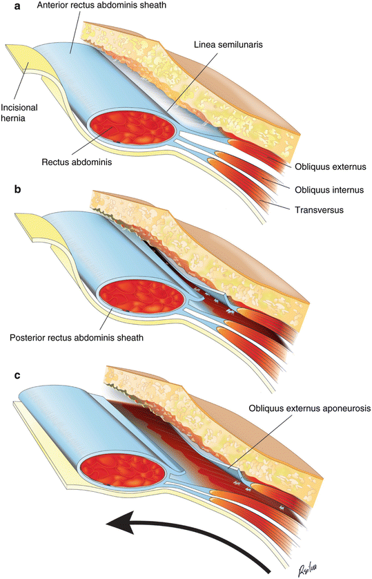 Riparazione laparocele - ricostruzione parete addominali