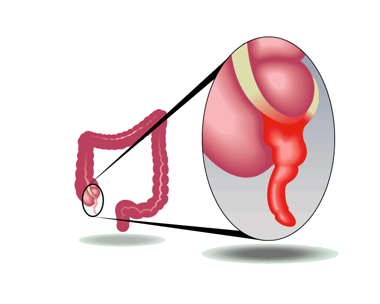 appendicite - appendicectomia