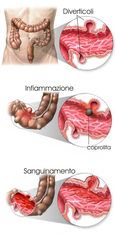Malattia diverticolare - Diverticolite