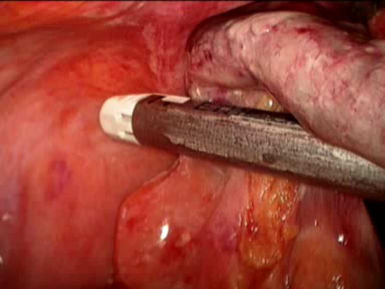 appendicectomia laparoscopica - appendicite - appendicectomia - ascesso appendicolare - peritonite