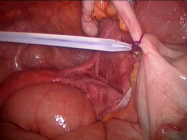 appendicite - appendicectomia