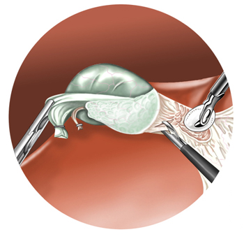 chirurgia mininvasiva
colecistectomia laparoscopica